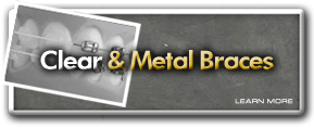 Clear and Metal Braces Toronto